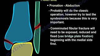 Ankle Fractures, Surgical Treatment ,tactics   Everything You Need To Know   Dr  Nabil Ebraheim