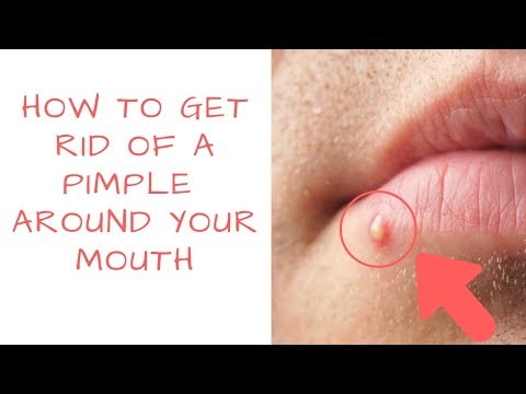 How to get rid of PIMPLES Around your mouth | PrettyBoyFloyd 🌹