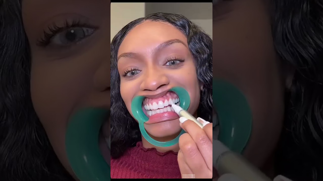 Новый беспроводной набор для отбеливания зубов Gurunanda — лучший из лучших! Вы заметите, что зуб...