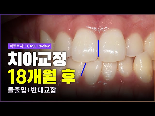 돌출입+반대교합 클리피씨교정으로🦷 | 전체교정 기간은❓
