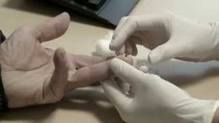 Blodpropforskning I Esbjerg