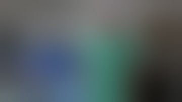 Mitomycin C Spongectomy - Finding the Lost Sponge