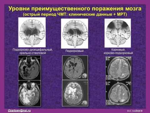 Синдромы помрачения сознания