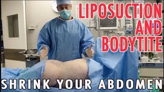 Liposuction and BodyTite to Shrink Abdomen and Melt Fat without a Tummy Tuck