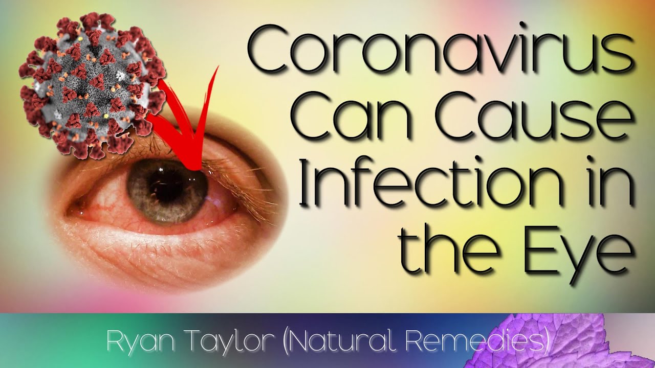 Coronavirus Conjunctivitis (COVID-19/SARS-CoV-2) Update 17th March 2020