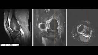 acute total ACL transecion with associated injuries screenshot 5