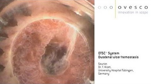 OTSC® System | Duodenal ulcer hemostasis
