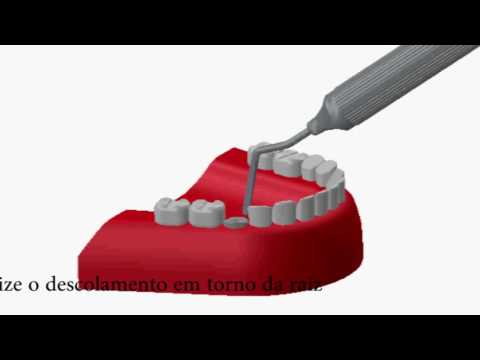 Vídeo: Como funcionam os extratores de dentes de sucção?