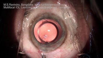 Multifocal IOL centring to Visual axis