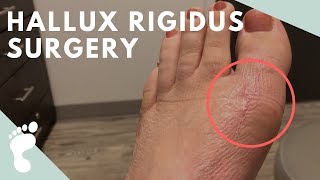 Hallux Rigidus YouTube