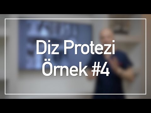 Diz Protezi Vaka Örnekleri #4