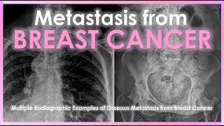 Metastasis from Breast Cancer #radiology #breastcancer #health