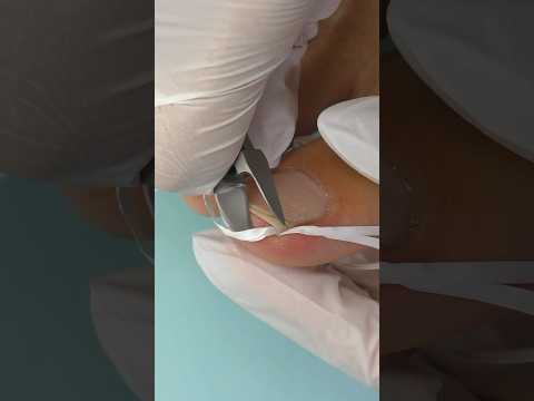 Video: Maneras sencillas de tratar un dedo del pie hinchado: 13 pasos (con imágenes)