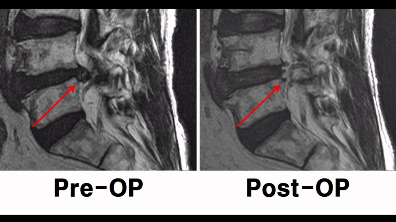 CKES for herniated lumbar disc with calcification YouTube
