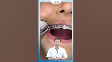 Cách Bác Sĩ Khắc Phục Tình Trạng Hô Móm Khi Niềng Răng | Nha Khoa Minh Châu