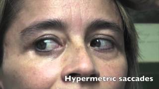Case Challenge: The patient had hypermetric saccades. (Video 1)