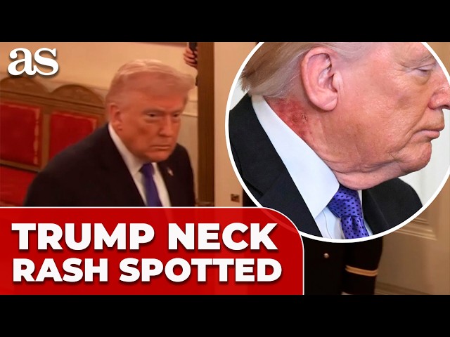 dress shirt neck rash President Donald Trump was seen with a rash on his neck during a White House Medal of Honor ceremony on Monday.