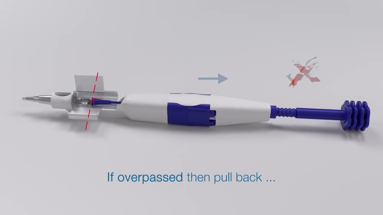 EVOLUX  Dual Injector – Suggested procedure instructions with NaHa viscoelastic solution