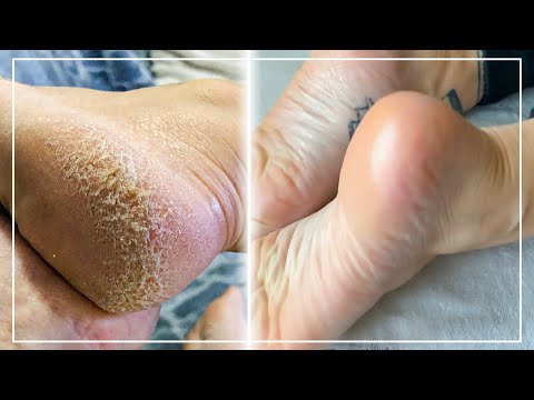 Vidéo: 3 façons d'adoucir et de lisser vos pieds