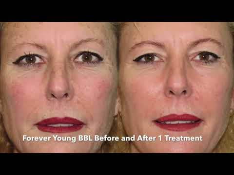Laser Acne Scar Removal, Acne scar treatment, Foreveryoung