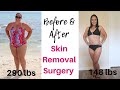 BEFORE & AFTER SKIN REMOVAL SURGERY AFTER VSG GASTRIC SLEEVE SURGERY 150 LB WEIGHT LOSS