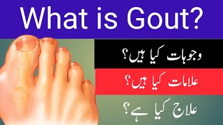Gout Causes, Symptoms and Treatment in Urdu/Hindi | Gout Causes and Treatment in Urdu/Hindi