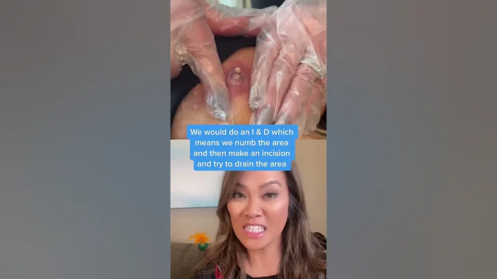 Dr Pimple Popper Reacts to Inflamed Cyst! #shorts ...