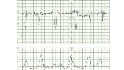 Decelerations Uncomplic Variables