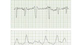 Decelerations Uncomplic Variables