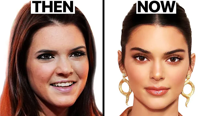 What Happened to Kendall Jenner's Face? | Plastic ...