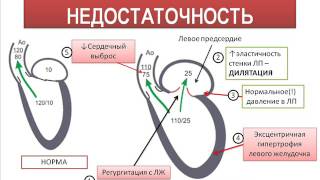 МИТРАЛЬНАЯ НЕДОСТАТОЧНОСТЬ АУСКУЛЬТАЦИЯ