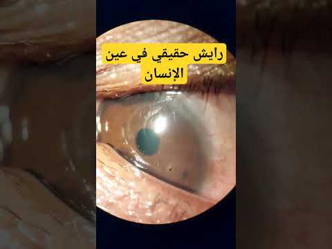 مشاهد حصرية رايش في عين إنسان العين العيون رايش 