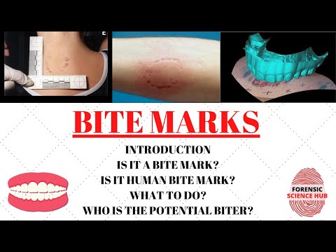 Bite marks | Forensic odontology | UGC NET Forensic science