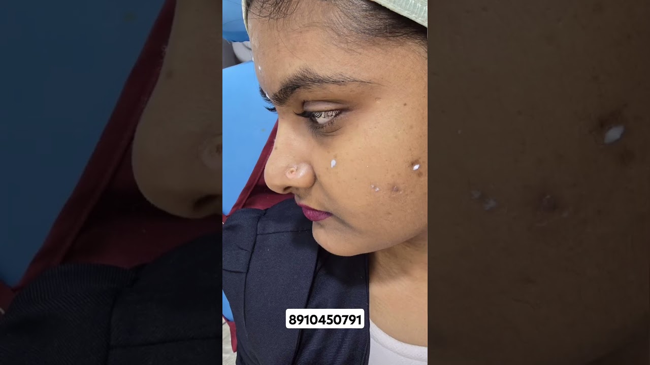 Watch Mole Removal|Innovation Dental & Cosmetic care #skincare#moleremoval#laser on YouTube Watch Mole Removal|Innovation Dental & Cosmetic care #skincare#moleremoval#laser on YouTube