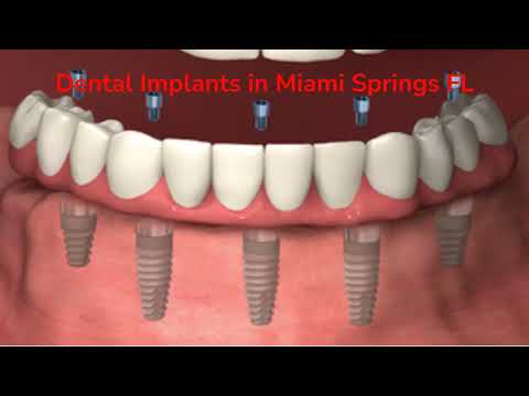Apple Dental Group : Dental Implants in Miami Springs, FL | 305-884-2751