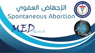 الإجهاض العفوي _ Spontaneous Abortion _ جامعة دمشق كلية الطب البشري