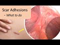 Scar Adhesion Symptoms Pain Prevention And Treatment mp3