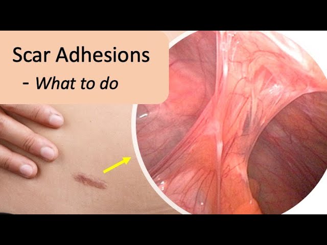 Scar Adhesion Symptoms, Pain, Prevention and Treatment. class=