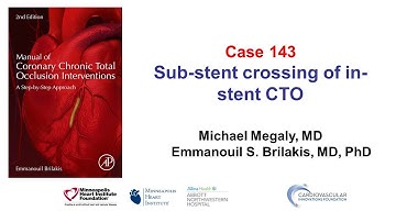 Case 143: Manual of CTO PCI - Sub stent crossing