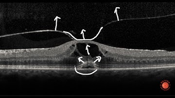 OCT Interpretation - Vitreous