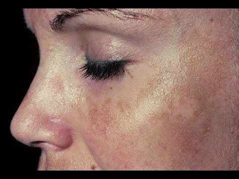 Video: 3 manieren om kurkumavlekken van de huid te verwijderen