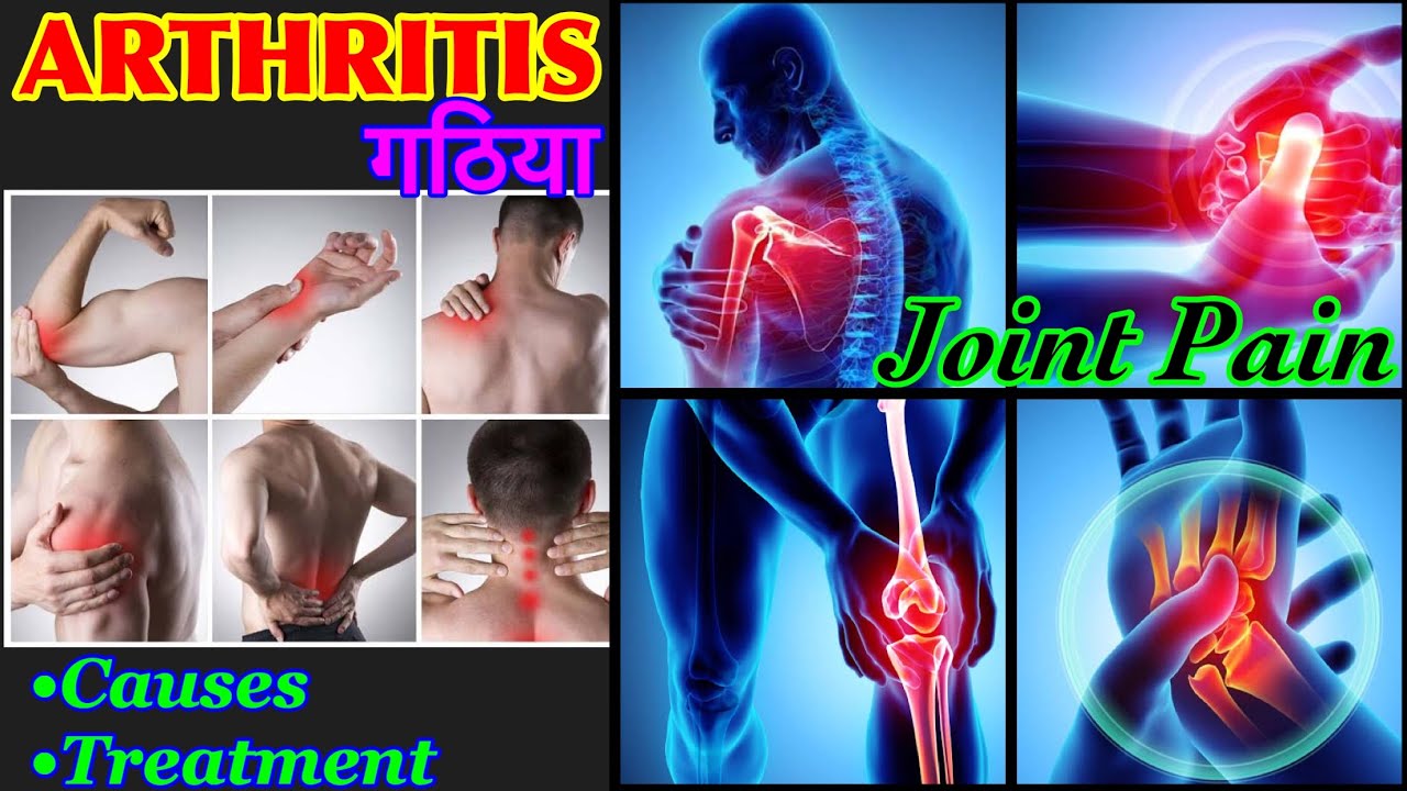 VESTIGE SUPPLEMENTS FOR ARTHRITIS (गठिया)| ARTHRITIS TREATMENT PRODUCT| JOINT PAIN (जोड़ों का दर्द )