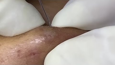 Pimple Popping Blackhead | Acne Removal Treatment | Blackheads and Whiteheads Extraction #0005 