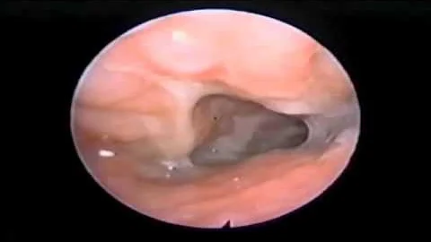 Endoscopy- Post-Therapy Improved Velopharyngeal Competence