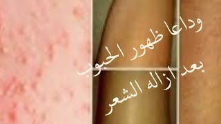 علاج حبوب الجسم بعد ازاله الشعر نهائيا خصوصا الوجه والمنطقه الحساسه وبعد الحفافه