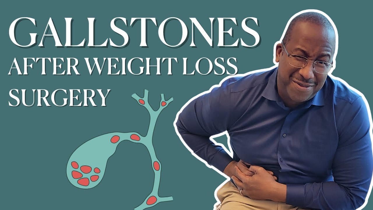 Why Bariatric Surgery Can Cause Gallstones YouTube