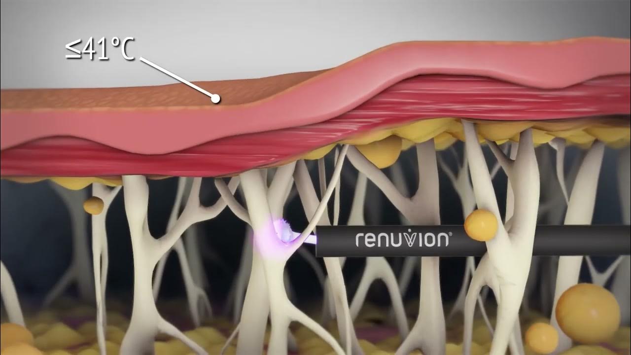 How Does Renuvion Skin Tightening Work? YouTube