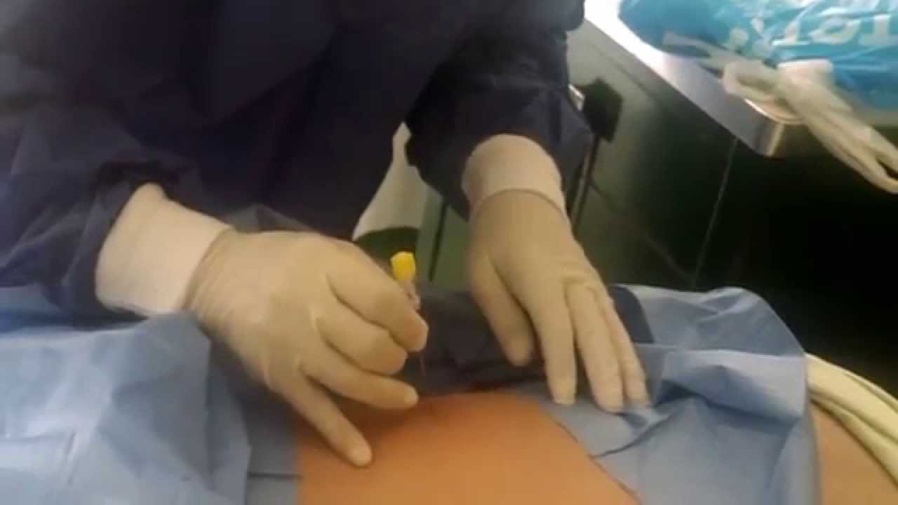 BIOPSIA RENAL PERCUTANEA Sin Guía Ecográfica. Dr. Renzo P. Valdivia