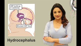 What’s hydrocephalus (fluid in baby’s head)??