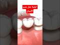 شاهد كيف يتم عمل كوبري جسر الأسنان الثابت